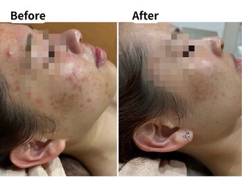 ムーロ バイ ミュー(muro. by mieux)/Before After