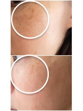 エステサロンパリス(Esthe Salon Paris)/しつこいシミも集中ケアでうすく