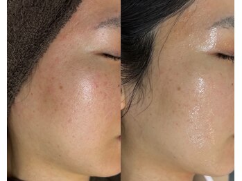 シェリー トウキョウ 西葛西店(Cherie Tokyo)/黒ずみ毛穴/開き毛穴解消◎