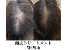 アムリリー 南草津店(AMRILY)/頭皮トリートメント
