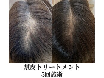 アムリリー 南草津店(AMRILY)/頭皮トリートメント