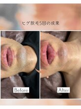 オフ(off)/ヒゲ脱毛