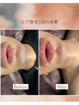 オフ(off)/ヒゲ脱毛