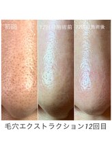 シェソワ(Chez soi)/毛穴エクストラクション12回目