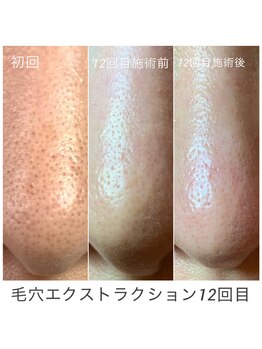 シェソワ(Chez soi)/毛穴エクストラクション12回目