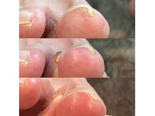 ユービーネイル(U be nail)の雰囲気（1度で感動！器具を使わない見た目もキレイな巻き爪補正！）