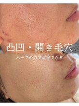 インテリウス(INteRius.)/頑固な肌トラブル改善