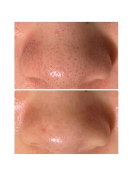 マリエンドリー/毛穴洗浄