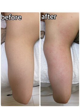 ルネ(Rune)/二の腕もスッキリ!