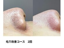 ボニータ(Bonita)/毛穴エクストラクション