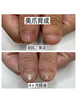 マニュコクーン(ManuCocoon)/爪育成 深爪 巻き爪 大阪市