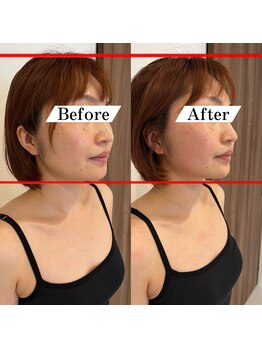 ドクターボディ 浜松店(Dr.Body)/【人中縮小/中顔面短縮】