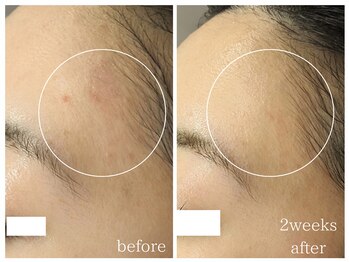 ラミーユ(La Miu)/肌質改善【二週間後の変化】