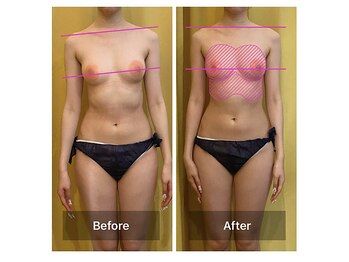 ベンザイ 梅田店(BENZAI)/体の歪みはバストが流れやすい