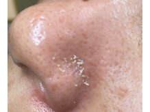 毛穴の奥から”ごっそり”詰まりを取り除きます。