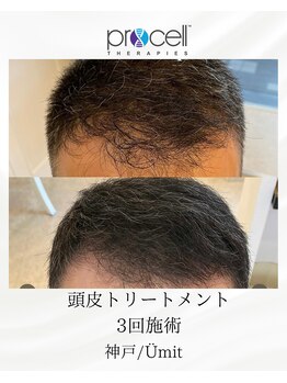 ユミト(Umit)/プロセルスカルプ