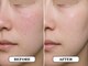 エース(ACE)の写真/【男性も美肌の時代】光フェイシャルで清潔感のある肌質改善!ニキビ・シミ・たるみ・毛穴などの改善に◎