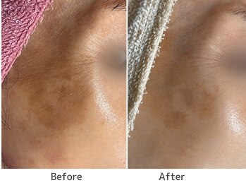トータルビューティー ココ(Total Beauty CoCo)の写真/【シミ改善専門】繰り返すシミに。独自の技術を組み合わせオーダーメイドで根本ケア