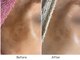トータルビューティー ココ(Total Beauty CoCo)の写真/【シミ改善専門】繰り返すシミに。独自の技術を組み合わせオーダーメイドで根本ケア