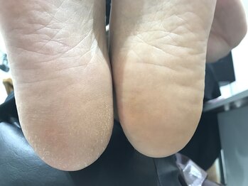 エムクチュール/角質ケア