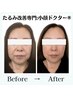 【とにかくたるみ改善したい！】たるみ改善小顔コース(90分)22000円