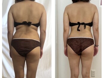 サロン ド モナ(salon de mona)/【後ろ姿ビフォーアフター】痩身