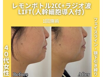 イーラボ 池袋店(e-LABO)/レモンボトル+ラジオ波Lift