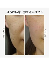 エイジングケア専門サロン サンク(thanq)/ほうれい線と頬のたるみ毛穴に