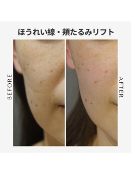 エイジングケア専門サロン サンク(thanq)/ほうれい線と頬のたるみ毛穴に