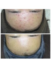 リラーナ(Re rana)/大人ニキビケア♪