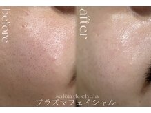 サロンドチュラ(salon de chula)/プラズマ/白玉肌/毛穴ケア