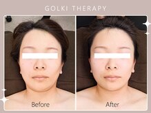 シロカネ イオンタウン西熊本店(SHIROKANE)/韓国式小顔コルギ☆