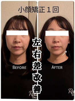 リバイブ 自由が丘店(REVIVE)/小顔矯正+ドライヘッドスパ1回