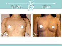 美人バスト 新潟店/ 【バストアップ★育乳】症例