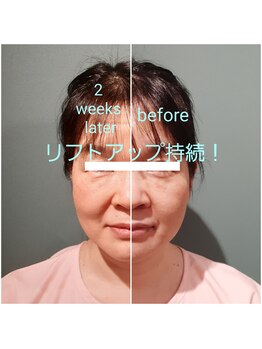 エルアンドエス(L&S)/幹細胞でリフトアップキープ！左