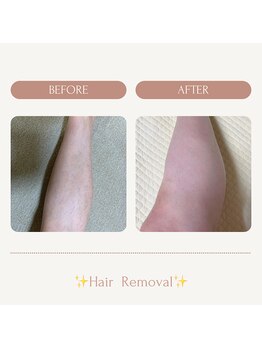 サロンエピ(Salon Epi)/両脚全体脱毛/メンズ脱毛/京都