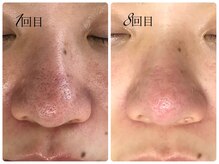 シェミー(CHEZ MEE)/【メンズ美容】黒ずみ/引締め