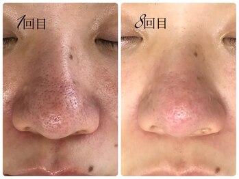 シェミー(CHEZ MEE)/【メンズ美容】黒ずみ/引締め