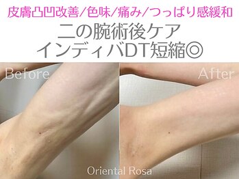 オリエンタルローザ 表参道(Oriental Rosa)/二の腕脂肪後インディバ術後ケア