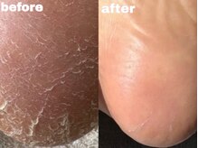 サゥオルサロン(sawalsalon)の雰囲気（ガサガサ角質からツルツル足裏に*タコ/魚の目/乾燥/黒ずみにも◎）