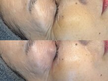 モナートドゥ(Monartdeux)/目元のシワ改善