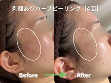 リソルバイスリール(Re:sol by sourire)/毛穴洗浄・ハーブピーリング専門