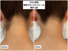 プレヴェール 神戸三宮/うなじ脱毛