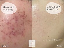 リル ビューティー ラボ(LILU BEAUTY LAB)の雰囲気（自社開発のハーブピーリングとホームケアの見直しでここまで改善）