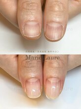 マリーロール 淀屋橋本店(Marie Laure)/自爪育成/深爪矯正/ネイルケア