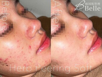 ベル 広島(Belle)/ハーブピーリング｜ニキビケア