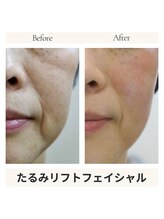 エイジングケア専門サロン サンク(thanq)/50代女性のためのフェイスリフト
