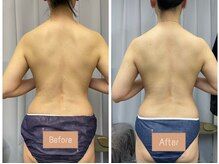 FJ/セル脂肪◇痩身◎