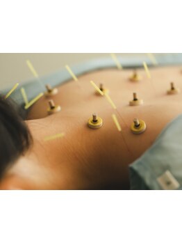 鍼灸施術を受けたい