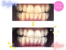 エクシアホワイト 宮崎花ヶ島店/ホワイトニングビフォーアフター